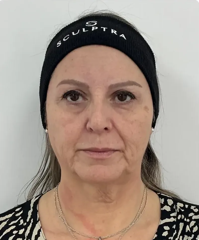 Rostro de frente antes de la armonización orofacial