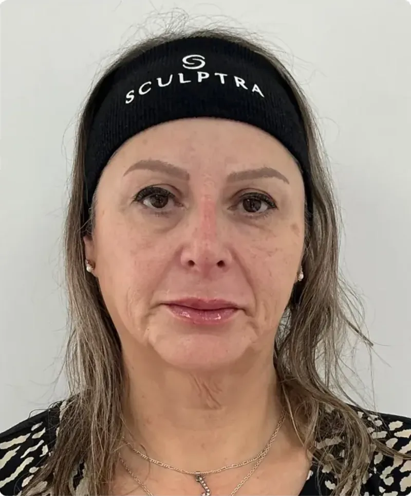 El mismo rostro de frente tras la armonización orofacial