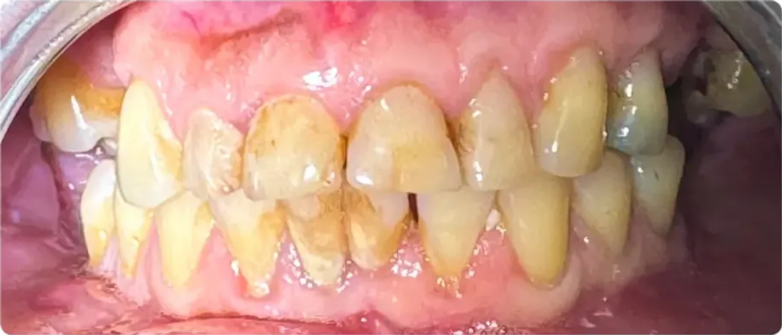 Primer plano de ambas arcadas con acumulación de sarro y encías inflamadas