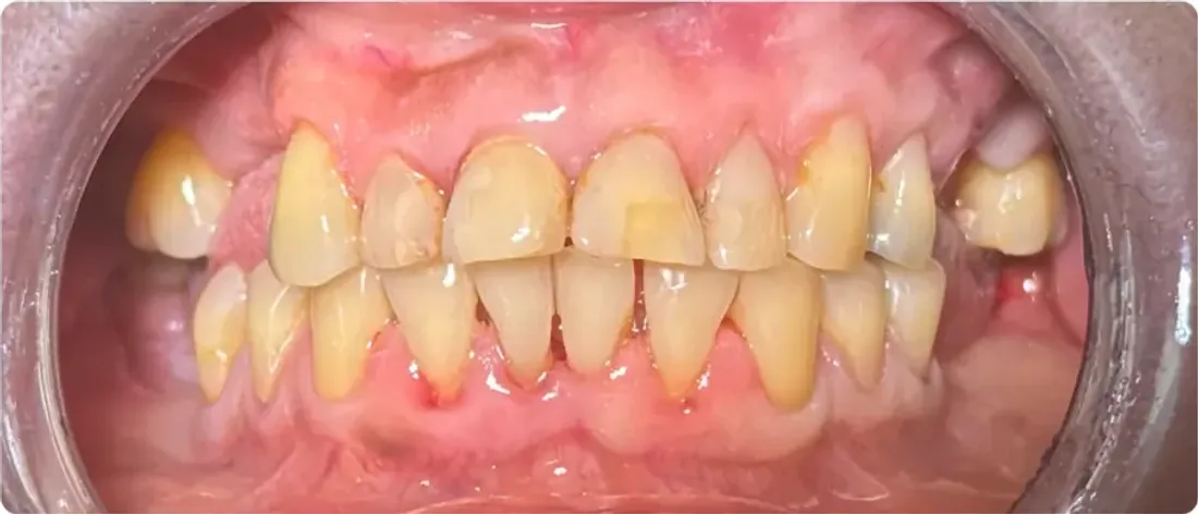 Las mismas arcadas tras el tratamiento periodontal, con las encías desinflamadas y las piezas limpias