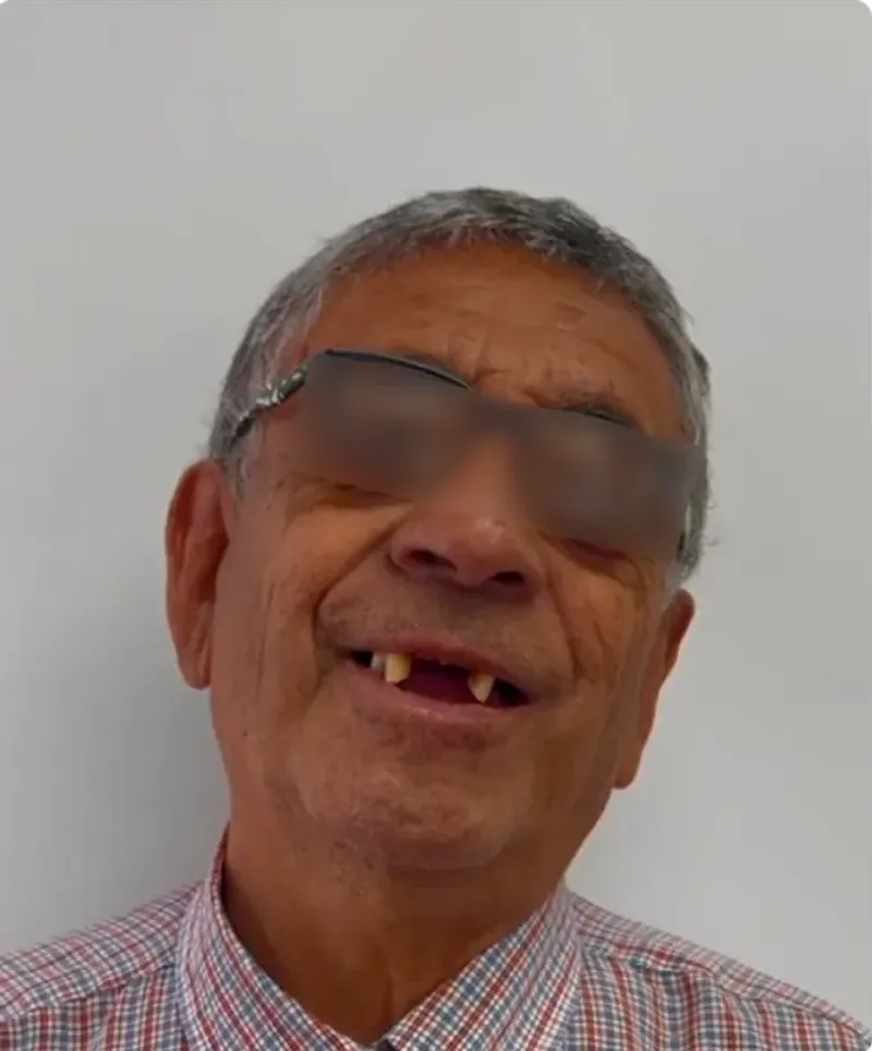 Hombre adulto mayor sonriendo antes del tratamiento, con pérdida de varias piezas anteriores