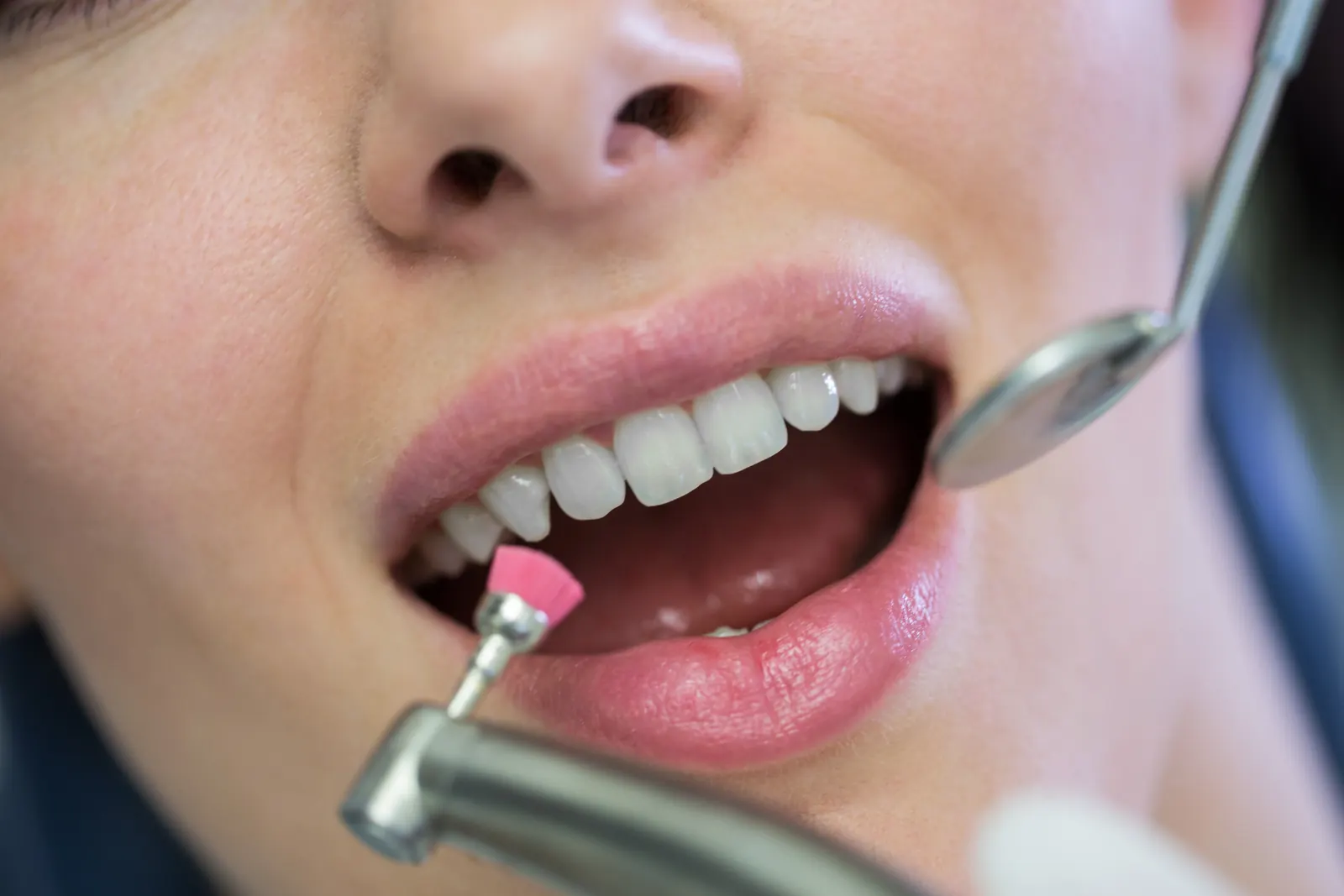 Higiene dental profesional