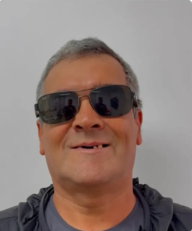 Hombre adulto sonriendo antes del tratamiento, con ausencia de piezas en el sector anterior superior