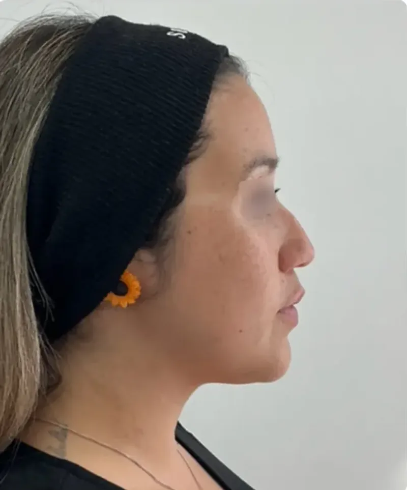 Perfil del rostro antes de la rinomodelación