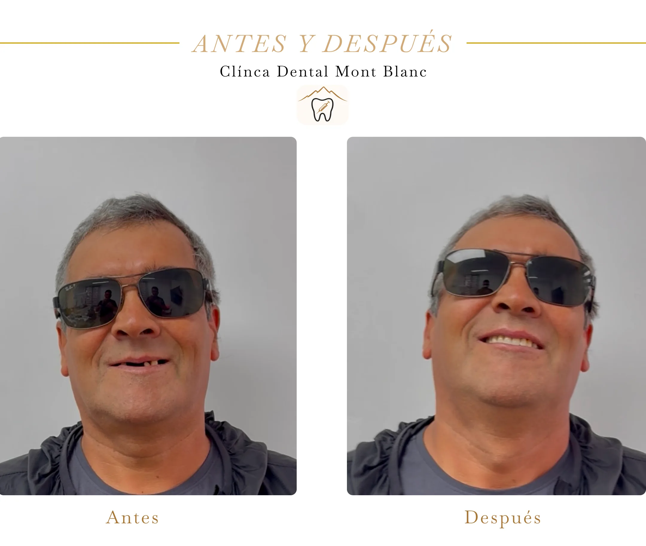 Caso de implantes dentales