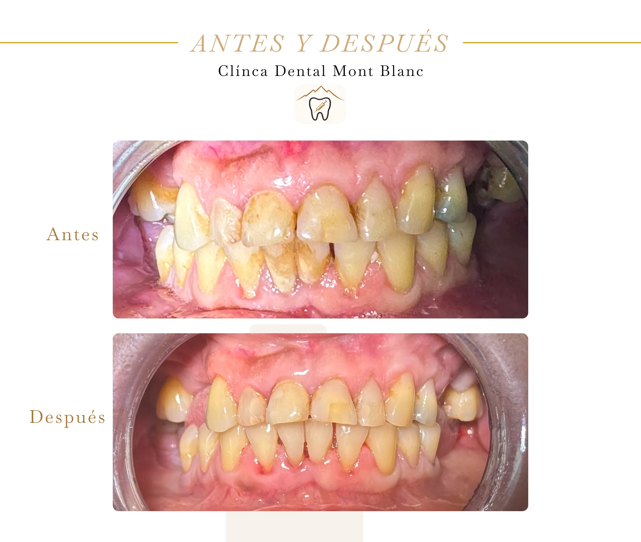 Resultado de tratamiento periodontal