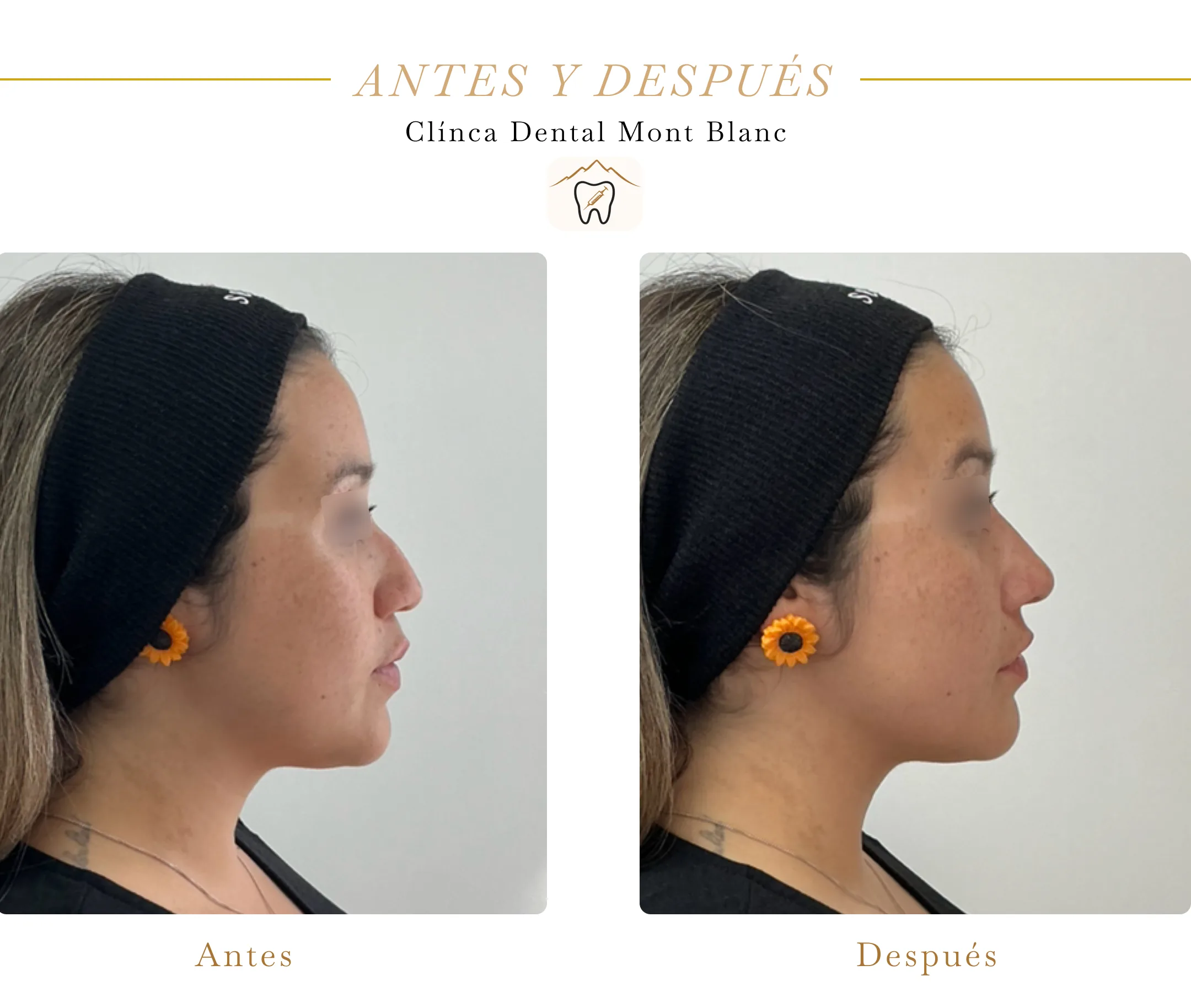 Resultado de rinomodelación con ácido hialurónico