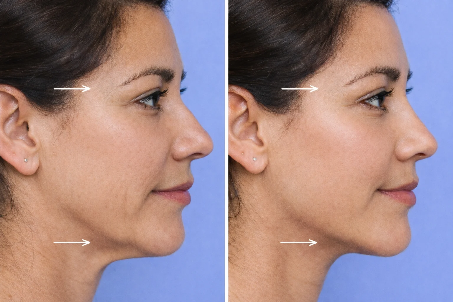 Aplicación de bioestimulador Sculptra en mejilla